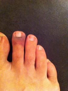 Toe